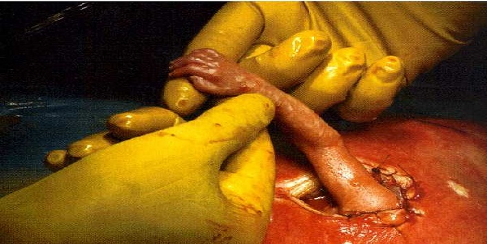 surgery in mothers womb2