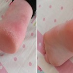 Crack Heels