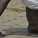 Elephantiasis