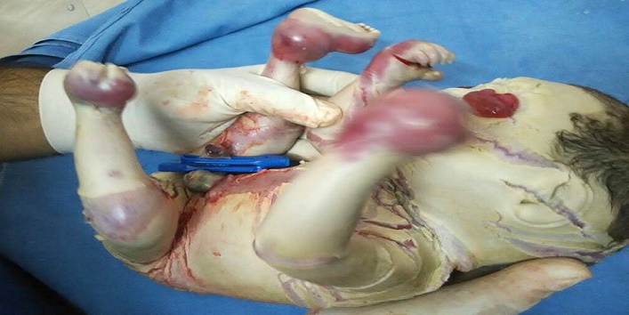harlequin baby born1