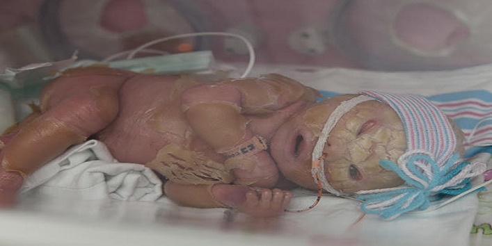 harlequin baby born2