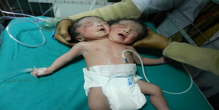 two head baby,two head baby born in India,Conjoined twins,mumbai,Lokmanya Tilak Municipal General Hospital,Sion Hospital,municipal hospital , hospital ,Mumbai hospital ,conjoined twins born baby