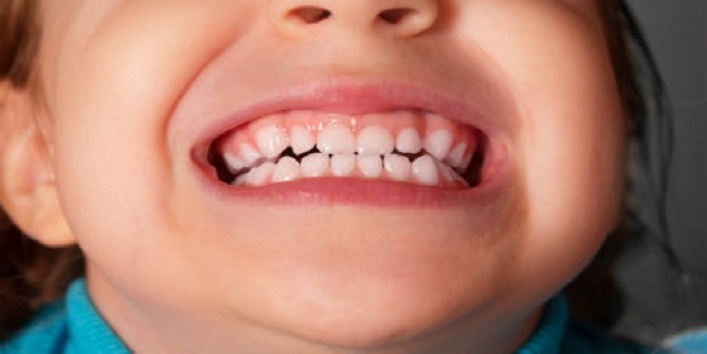 इस बच्चें के मुंह में निकले 80 दांत