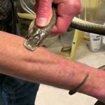 snake bite