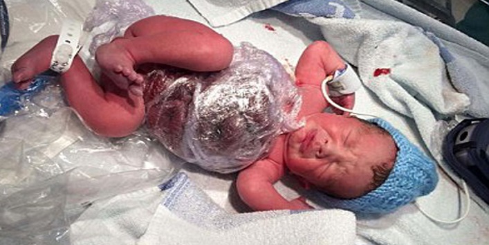 baby-born-with-his-organs-outside-his-body 1