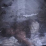22-metal-glass-objects-from-womans-stomach1