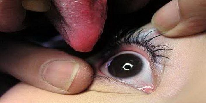 woman-cures-eye-problems-by-licking2