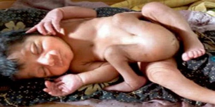भारत में हुआ 4 पैर और 2 लिंग वाले बच्चे का जन्म, डॉक्टर भी हैरान