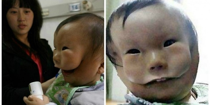 मास्क चाइल्ड – चेहरे पर मास्क लगाए हुए पैदा हुआ यह बच्चा