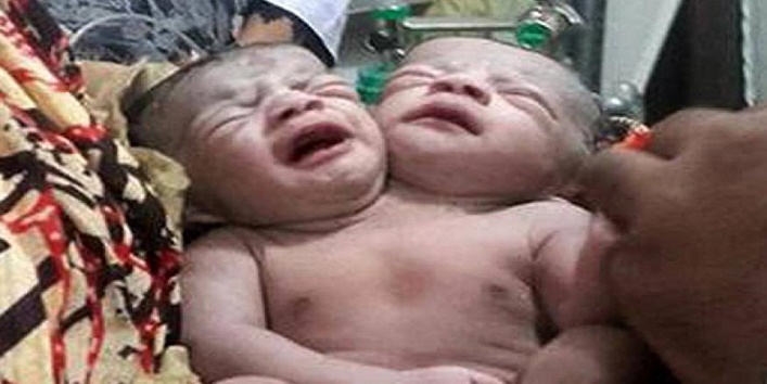 महिला ने दिया दो सिर वाले बच्चे को जन्म, लोग चकित