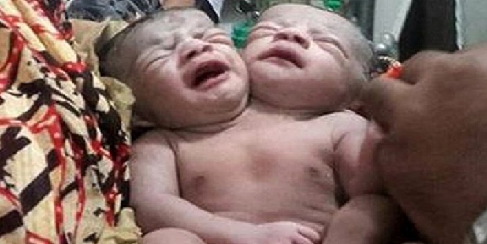 अजीबोगरीब बच्चा – देश में दो सिर वाले बच्चे ने लिया जन्म, लोग हैरान