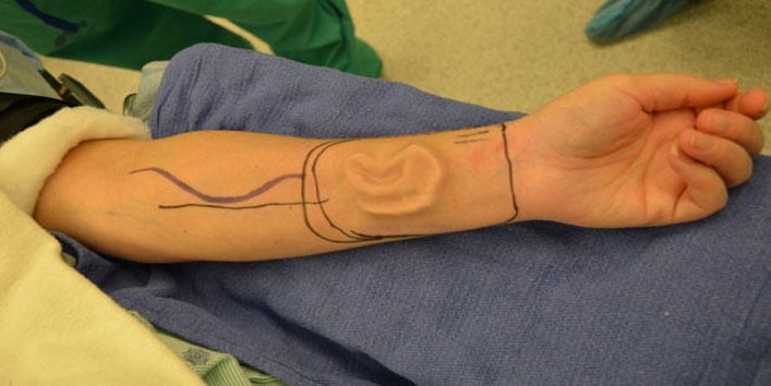 मेडिकल साइंस – इस डॉक्टर ने हाथ पर उगा डाले मानव के कान
